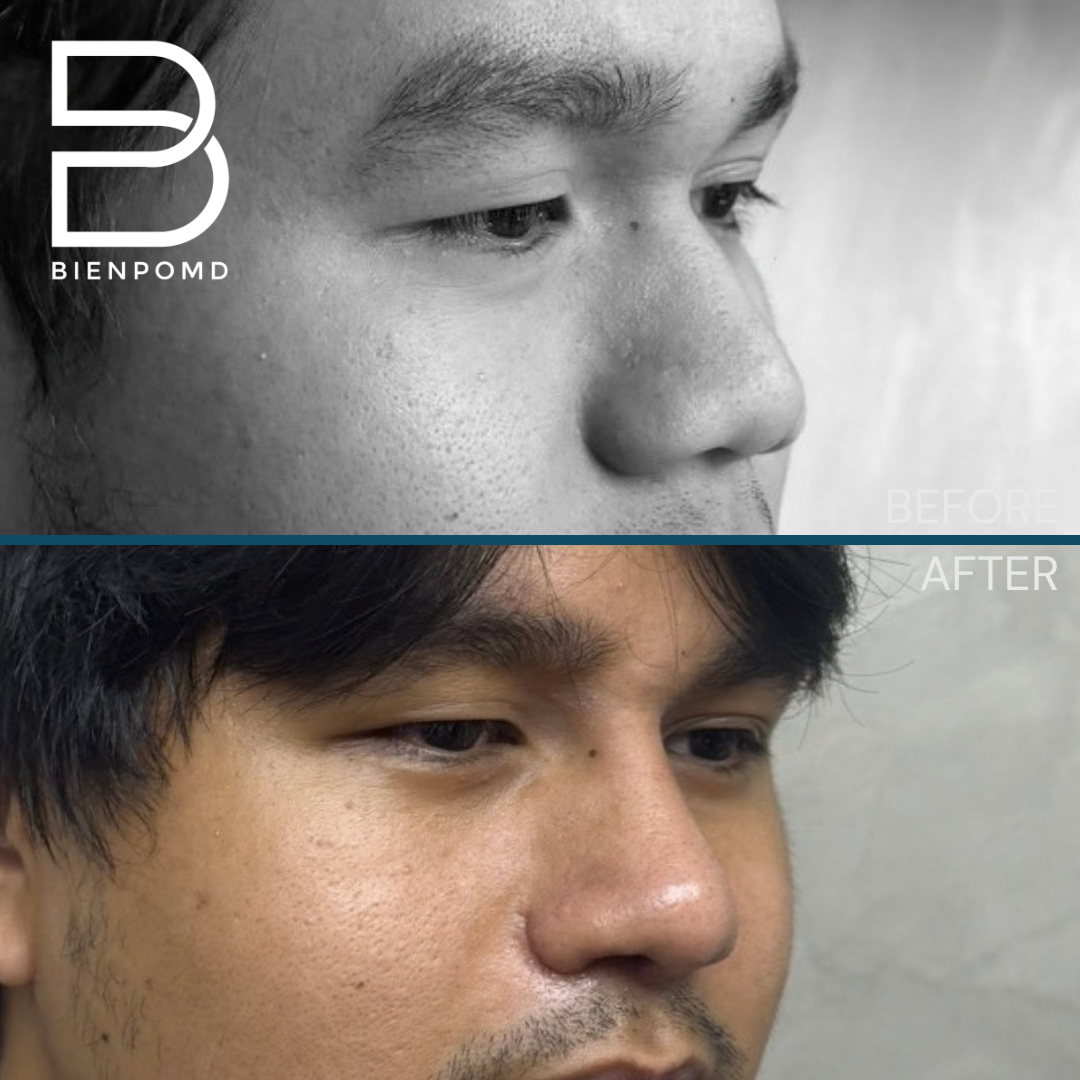 Before and 2 weeks after Gore-Tex (ePTFE) rhinoplasty, tipplasty using ear and irradiated rib cartilage, and alarplasty — view 3. This is an early healing result; individual results vary.