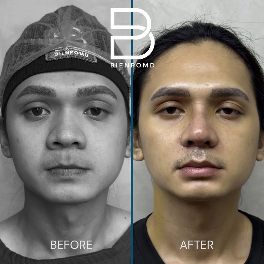 One-week transformation after Open Rhinoplasty with an ePTFE implant, irradiated rib and conchal-cartilage tipplasty, combined with Alarplasty.