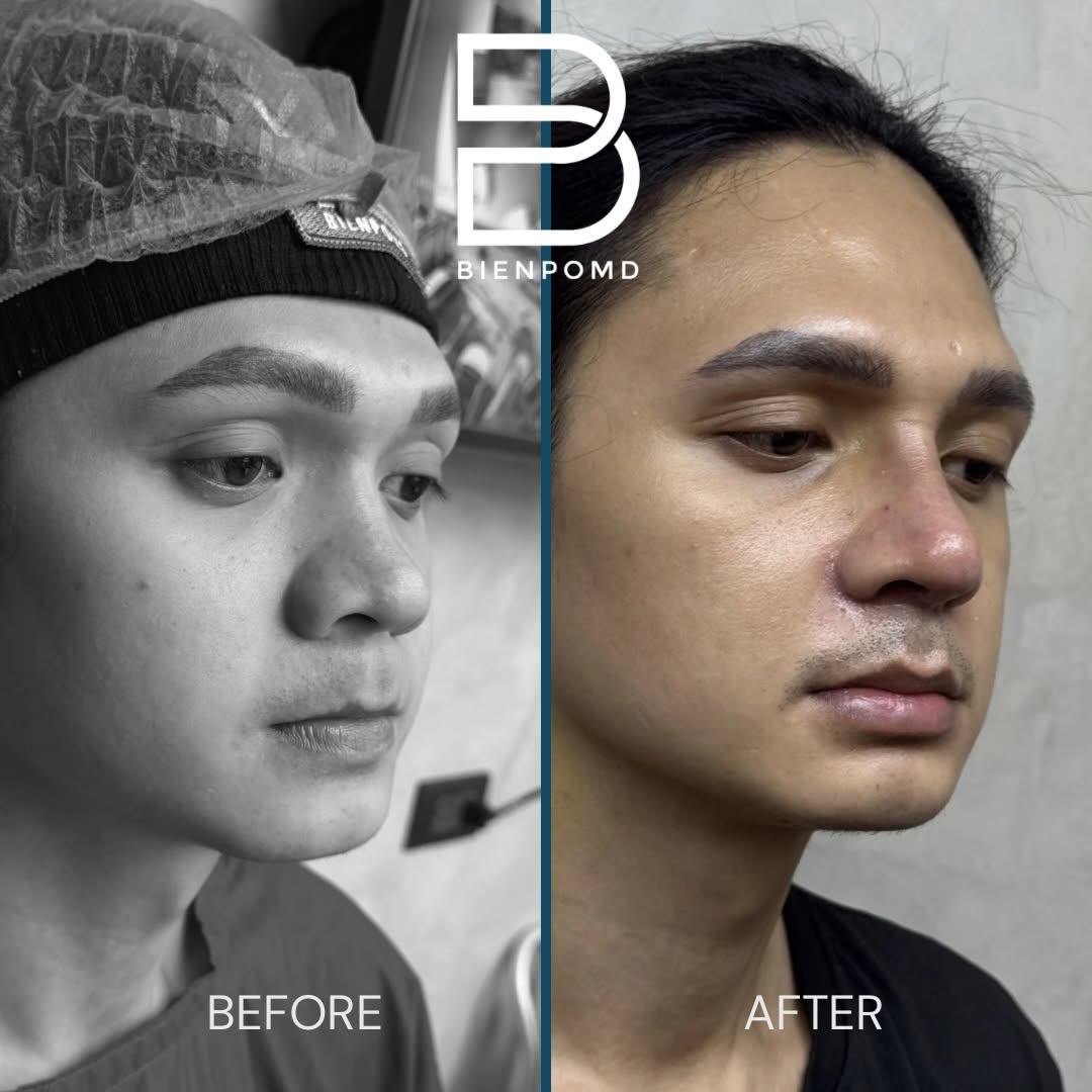 One-week transformation after Open Rhinoplasty with an ePTFE implant, irradiated rib and conchal-cartilage tipplasty, combined with Alarplasty.