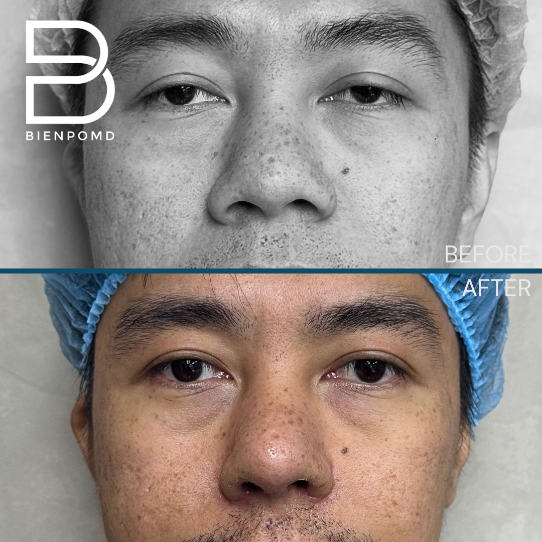 Front view before and one week after Tipplasty using irradiated rib and ear cartilage with Alarplasty