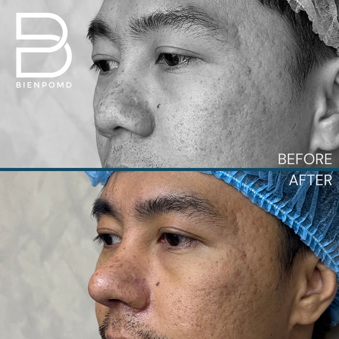 Left oblique view before and one week after Tipplasty using irradiated rib and ear cartilage with Alarplasty
