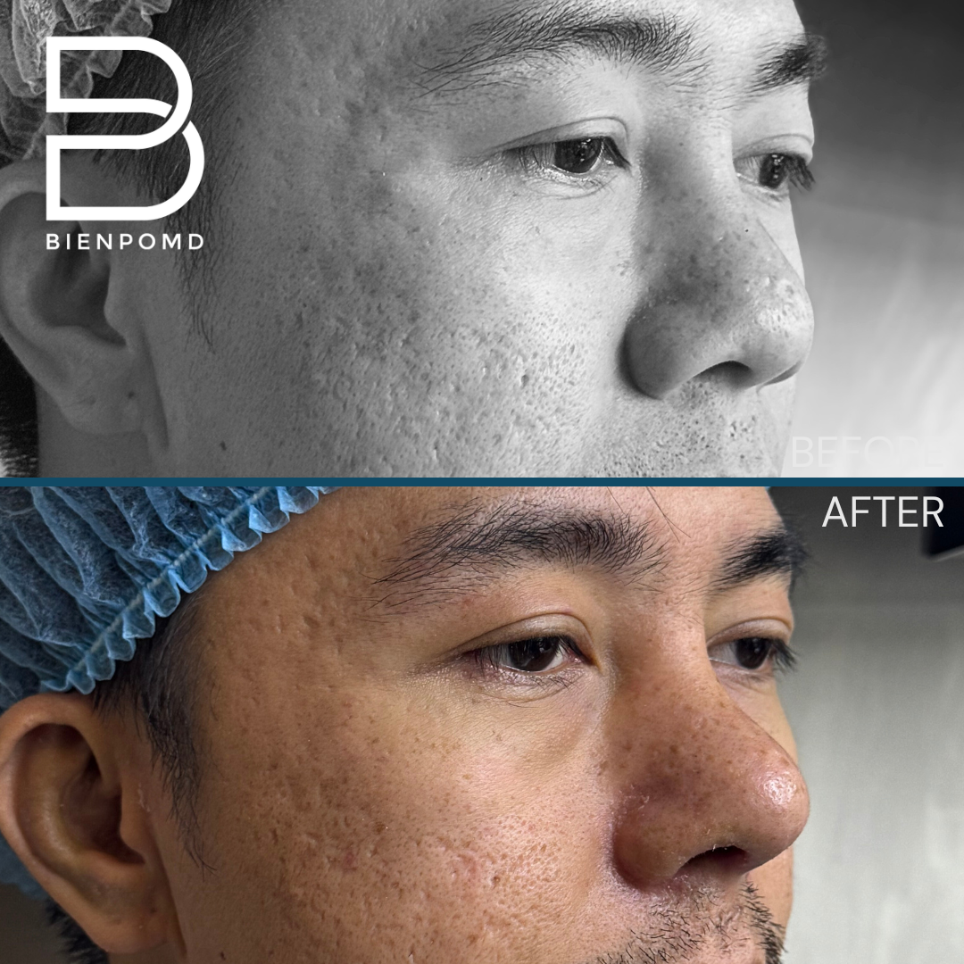 Right oblique view before and one week after Tipplasty using irradiated rib and ear cartilage with Alarplasty