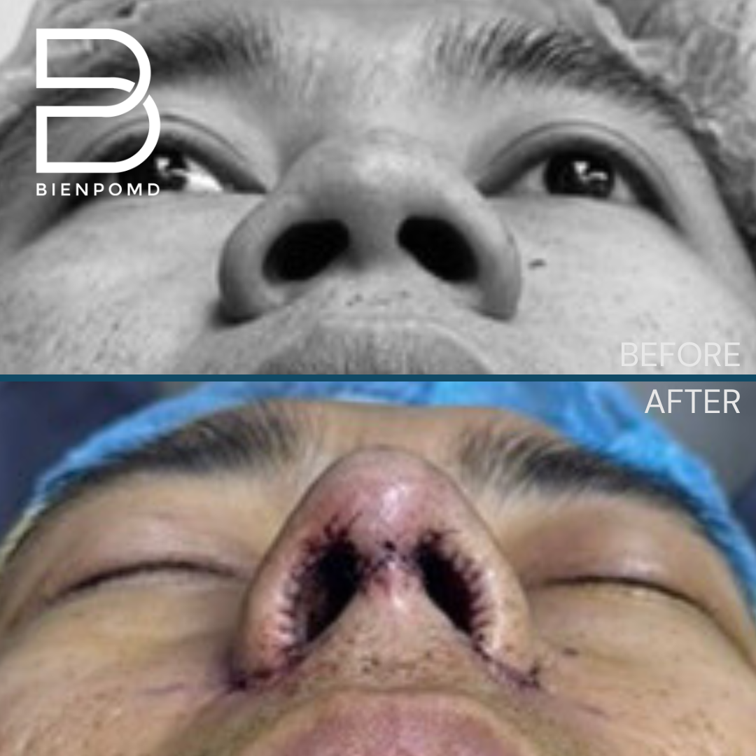 Basal view before and immediately after Tipplasty using irradiated rib and ear cartilage with Alarplasty