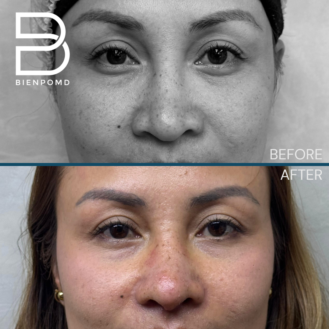 Front view before and one week after Tipplasty using irradiated rib and ear cartilage