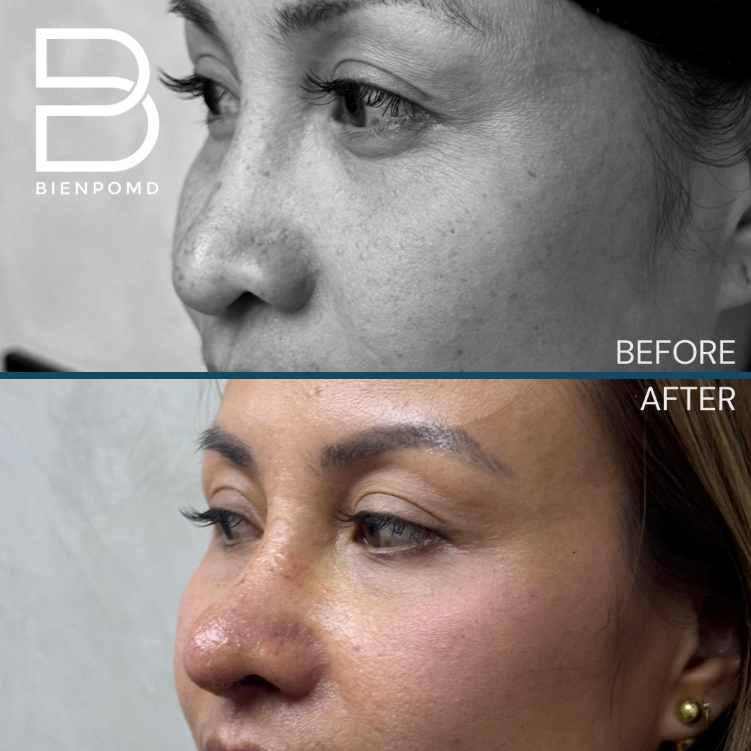 Left oblique view before and one week after Tipplasty using irradiated rib and ear cartilage