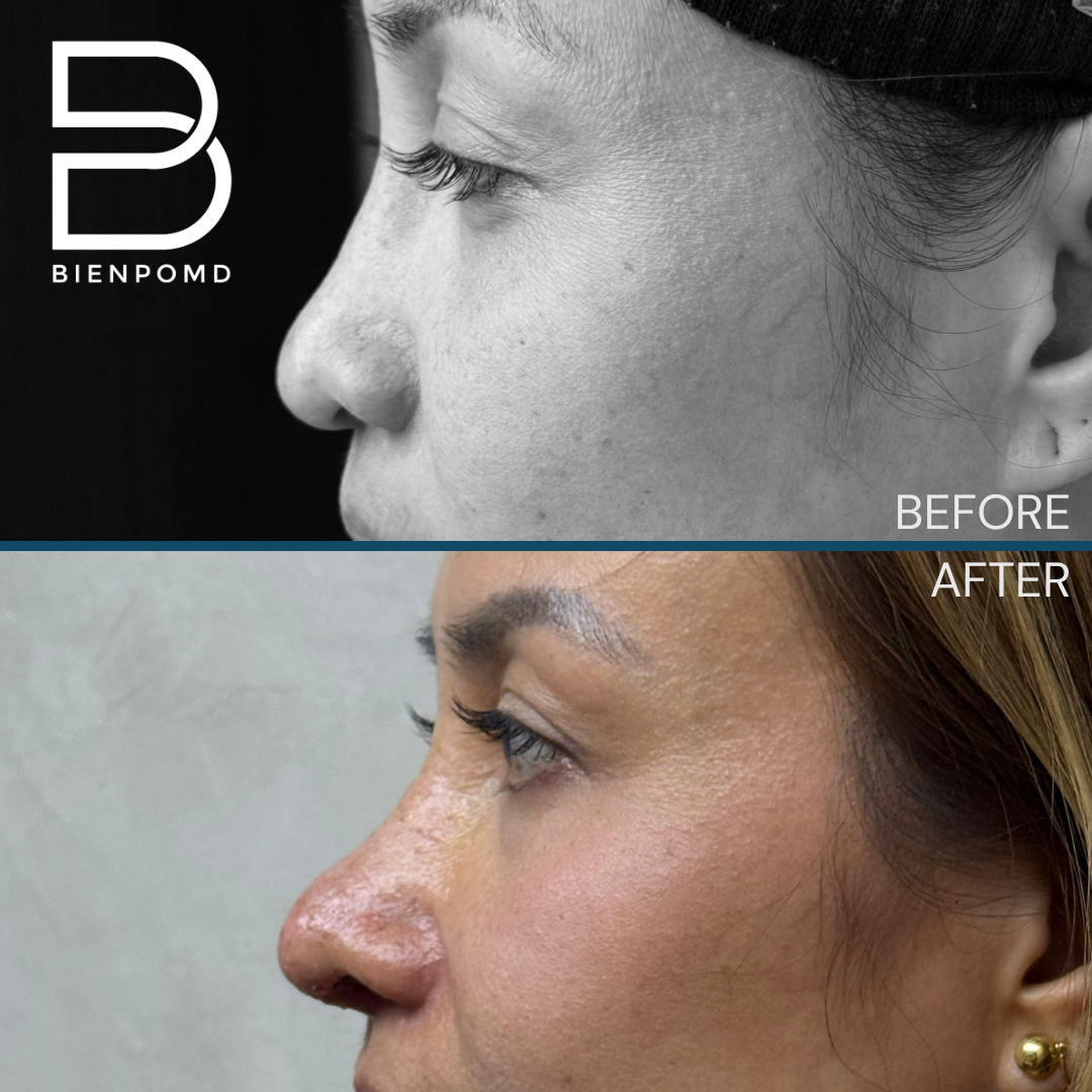 Left profile view before and one week after Tipplasty using irradiated rib and ear cartilage