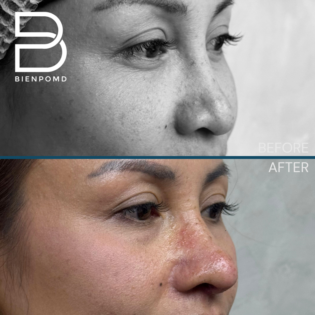 Right oblique view before and one week after Tipplasty using irradiated rib and ear cartilage