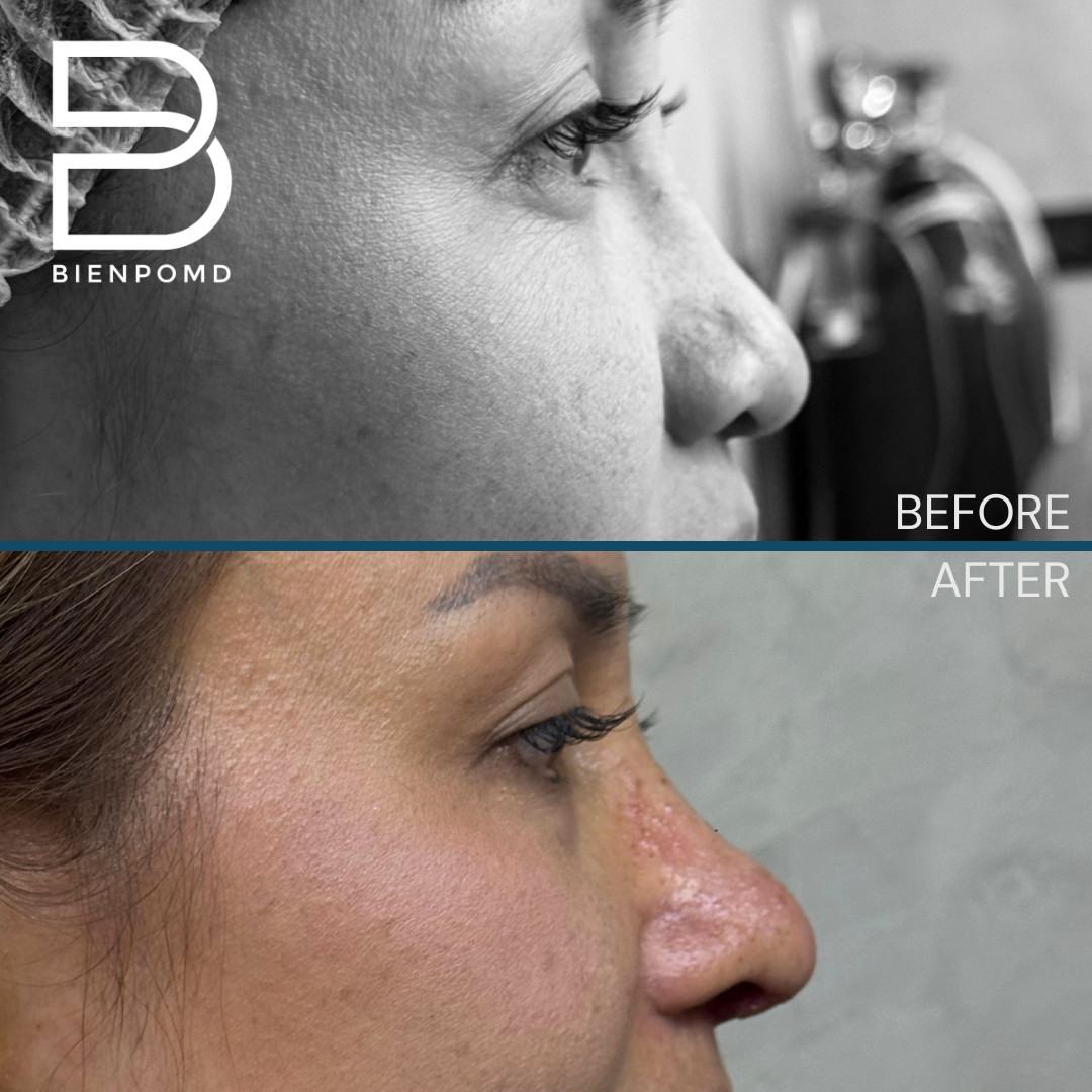 Right profile view before and one week after Tipplasty using irradiated rib and ear cartilage