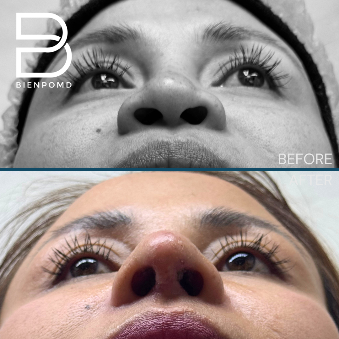 Basal view before and one week after Tipplasty using irradiated rib and ear cartilage