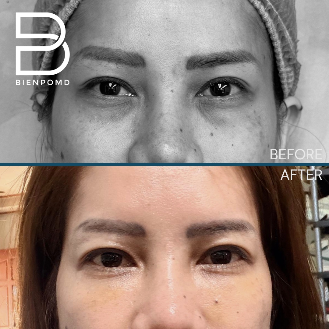 One-week before-and-after result following under-eye fat graft transfer combined with Picolaser treatment for hyperpigmentation