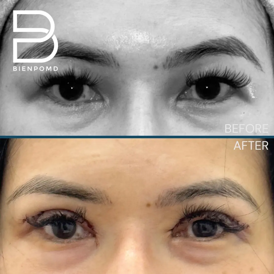 Upper Blepharoplasty before and after patient result