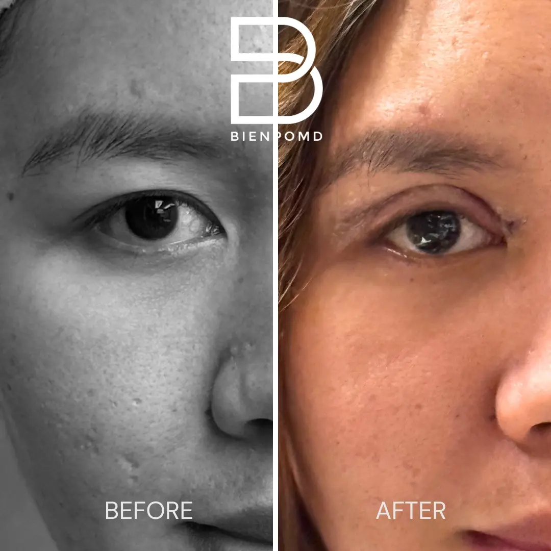 Upper Blepharoplasty before and after patient result