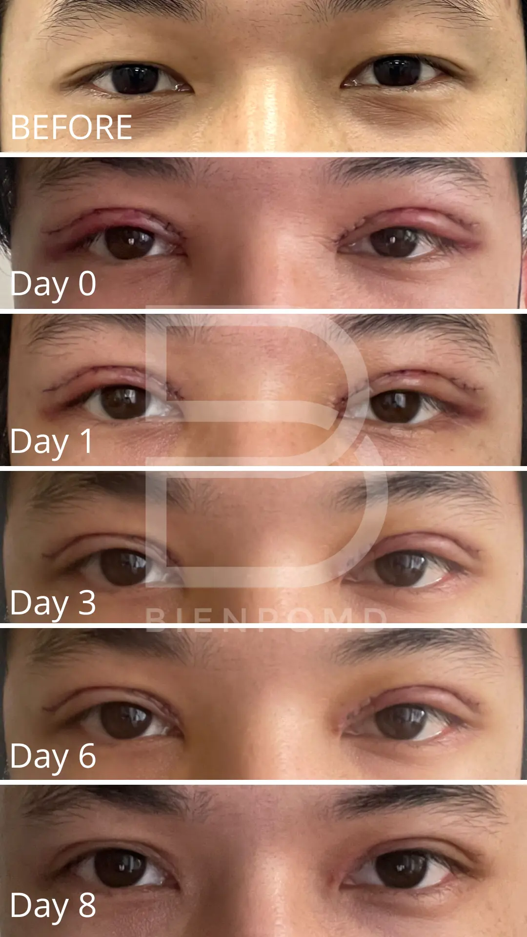 Upper Blepharoplasty healing journey from Day 0 to Day 8.