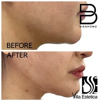 V-Line Liposuction before and after patient result