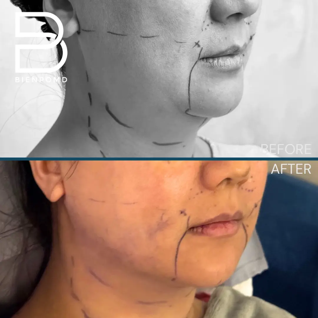 V-Line Liposuction before and after patient result