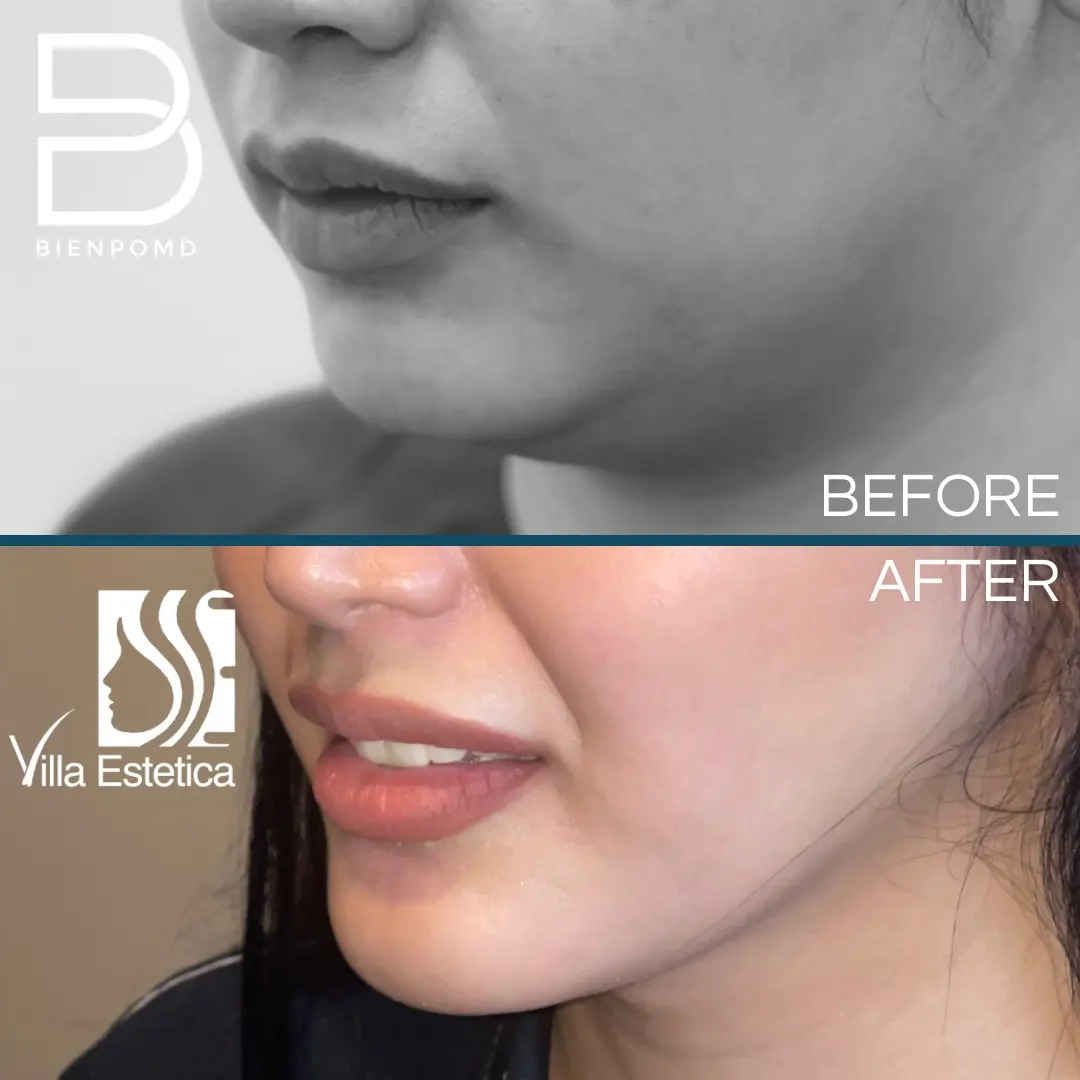 V-Line Liposuction before and after patient result