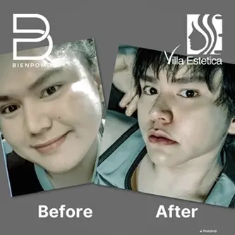 One month transformation after V-Line Liposuction.