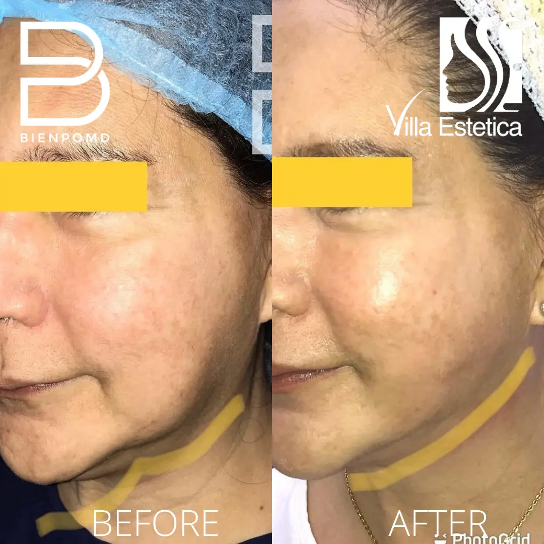 Two weeks transformation after V-Line Liposuction.