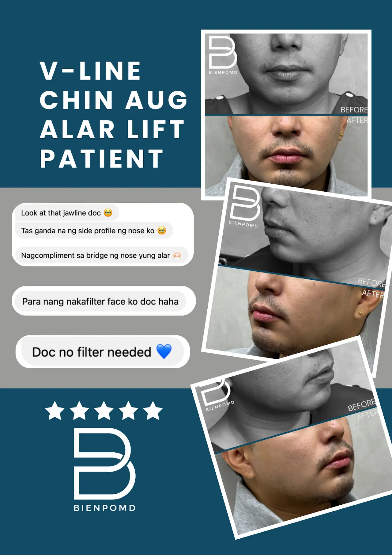 V-Line, chin augmentation, and Alarplasty patient review about attentive follow-up care