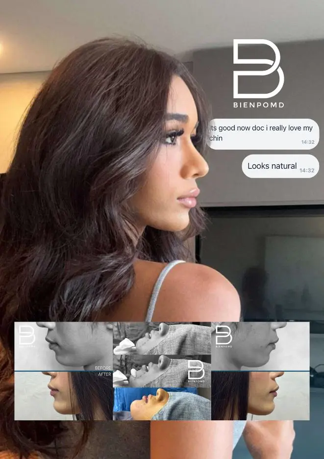 Chin Augmentation patient review from the original BienPoMD website