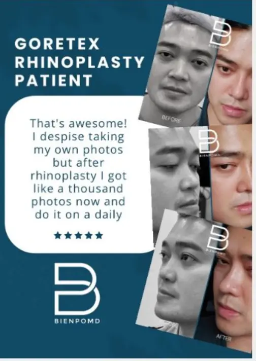 Gore-Tex Rhinoplasty patient review about increased confidence and daily photos