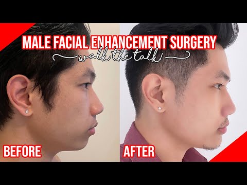 Chin augmentation video preview from Jobel and Gerard