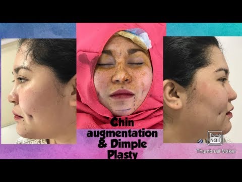 Chin augmentation and Dimplasty YouTube video preview
