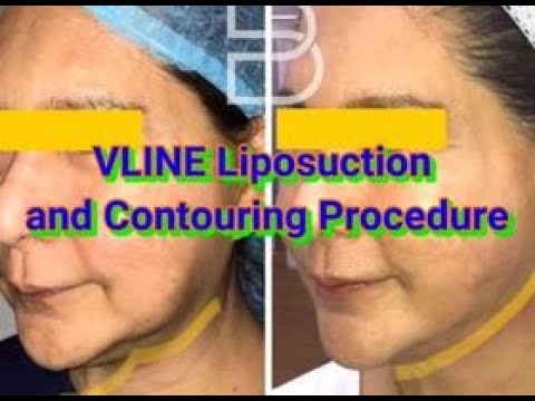 V-Line liposuction video preview from 1palangganation