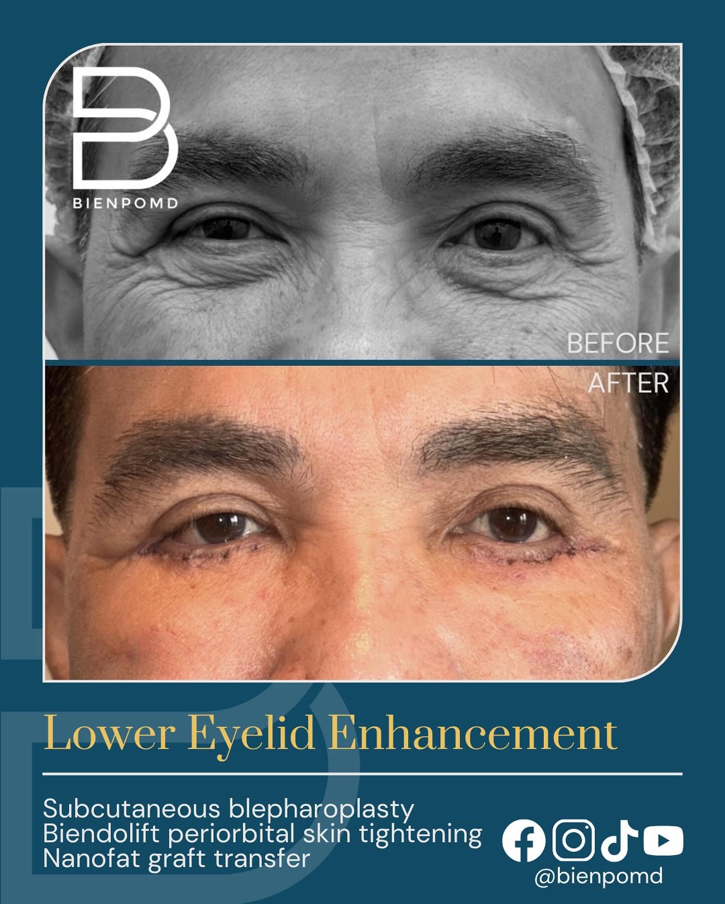 Combined Lower-Eyelid Enhancement before-and-after comparison