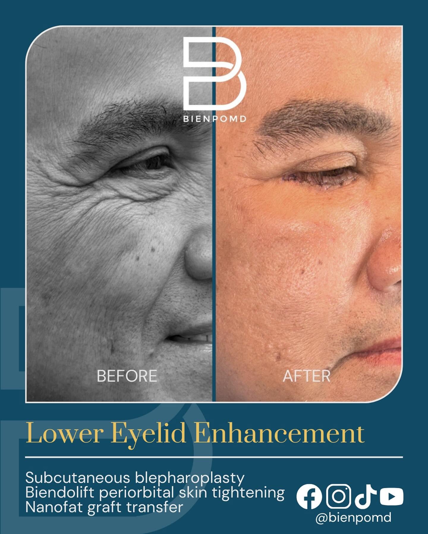Combined Lower-Eyelid Enhancement before-and-after comparison