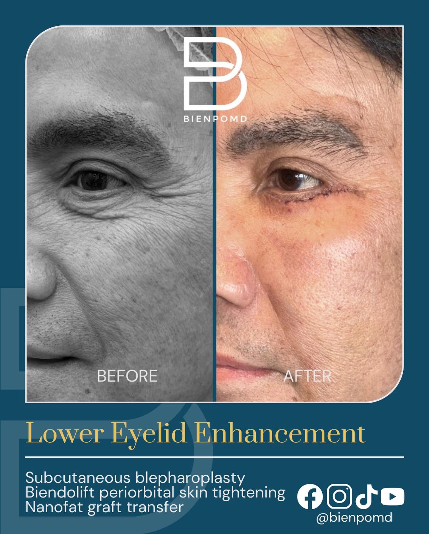 Combined Lower-Eyelid Enhancement before-and-after comparison