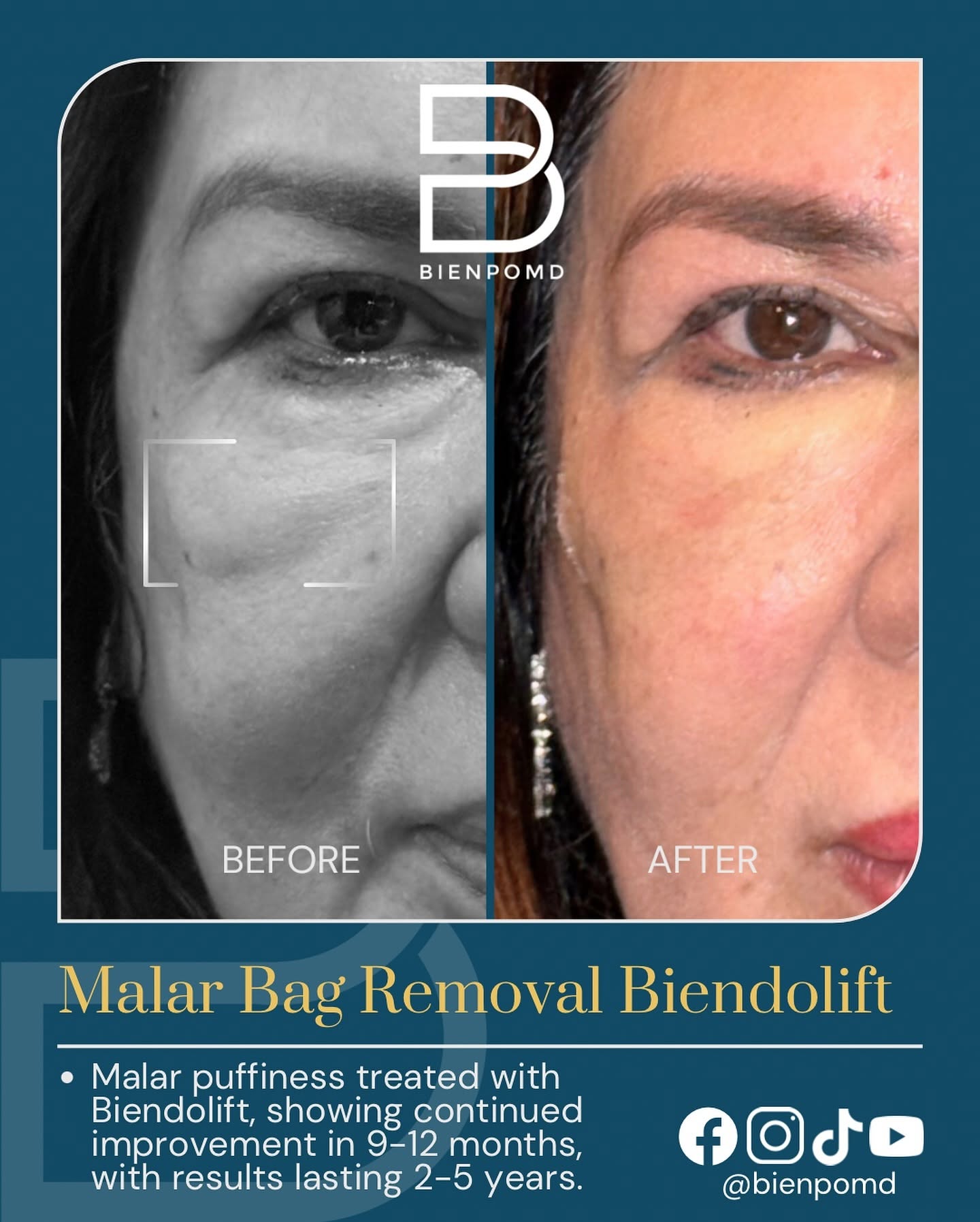 Biendolift Malar Region before-and-after comparison