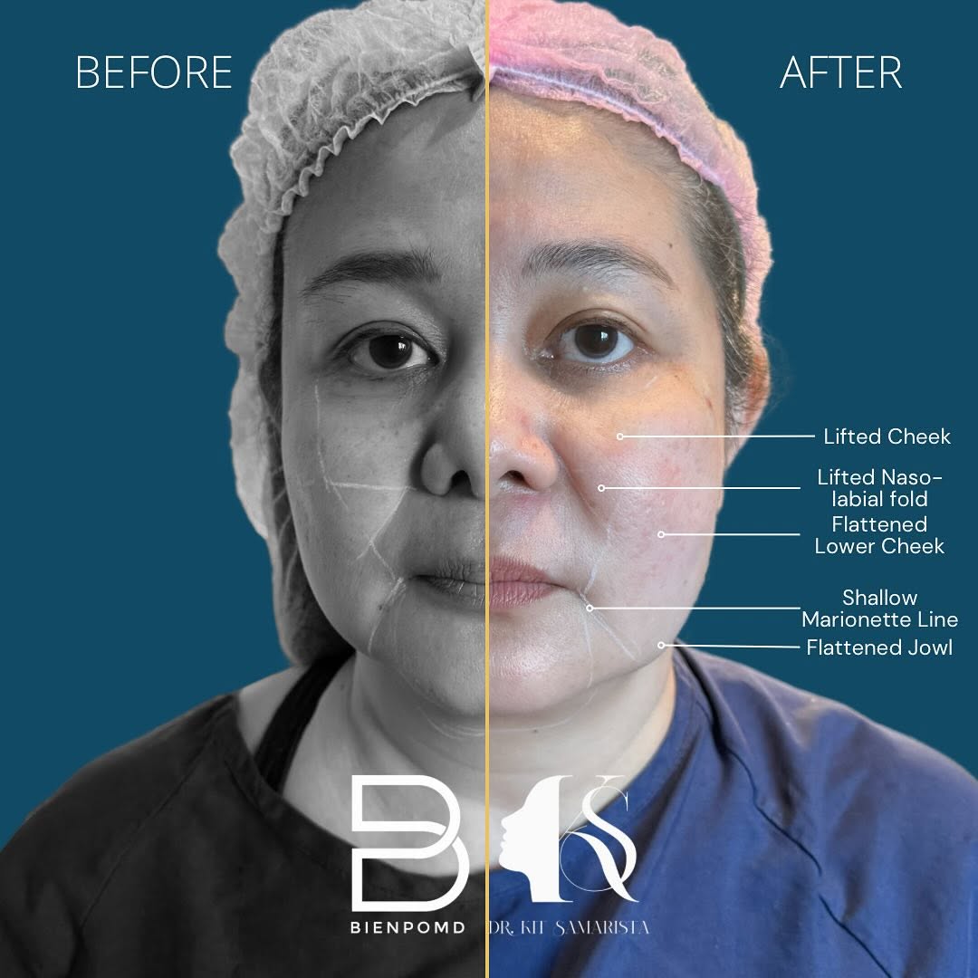 Biendolift Mid & Lower Face before-and-after comparison