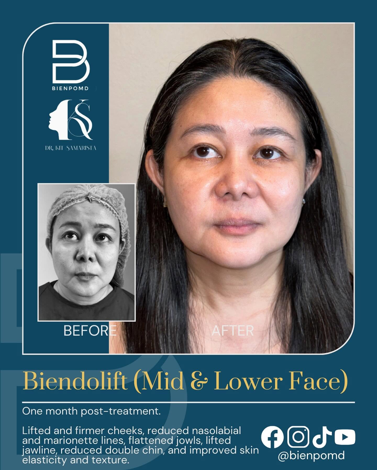 Biendolift Mid & Lower Face before-and-after comparison