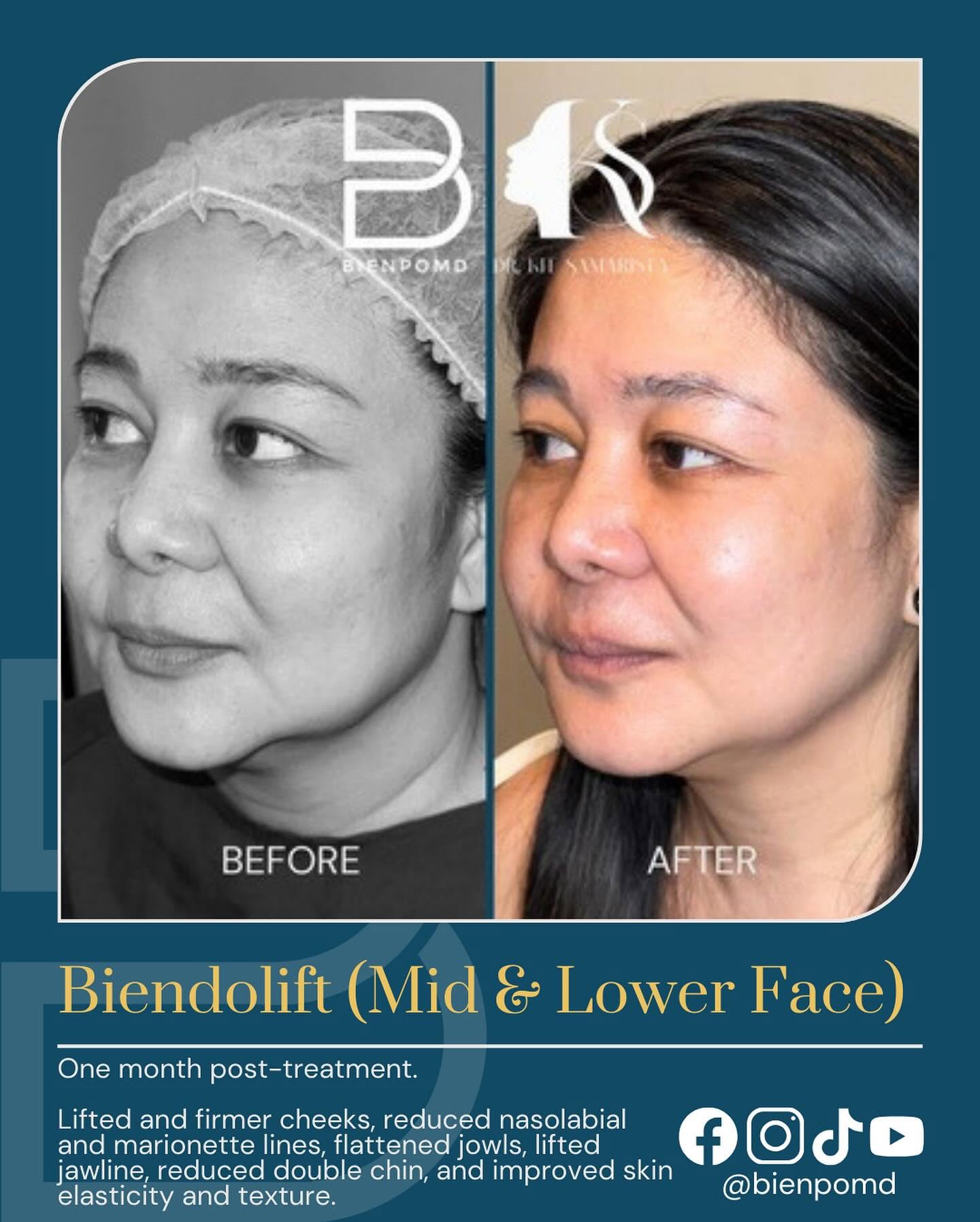 Biendolift Mid & Lower Face before-and-after comparison