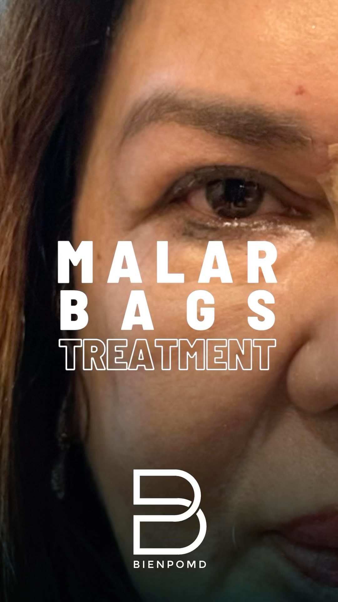 Biendolift Malar Bags Treatment video cover