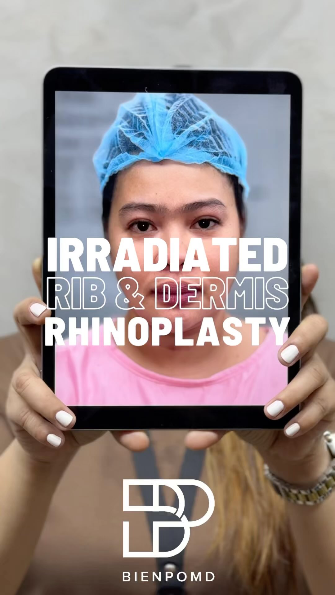 Facebook video about irradiated rib and acellular dermis, part 2 video cover