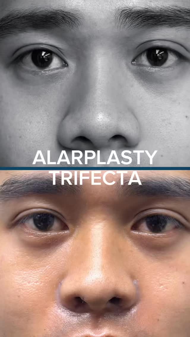 Wide Nostril Causes and Treatment Planning thumbnail