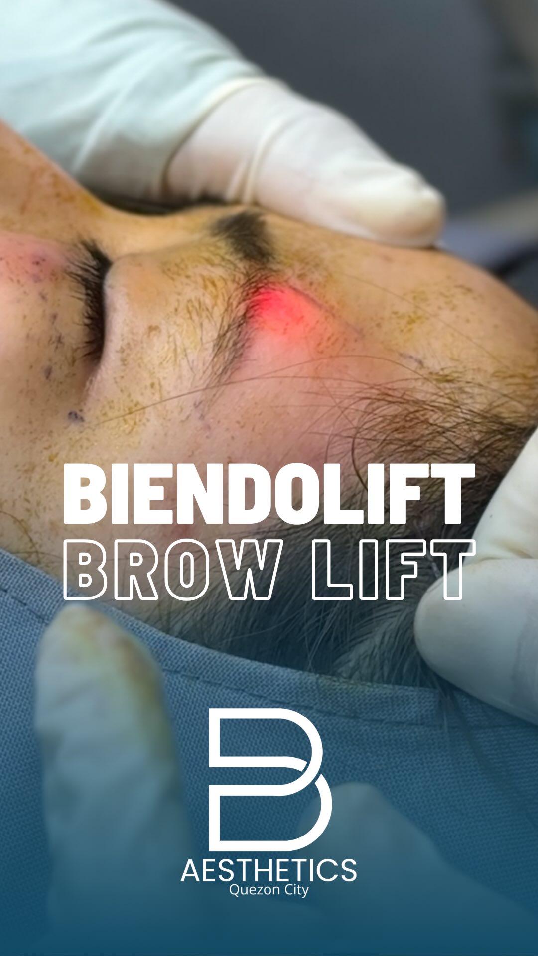 Biendolift Brow Lift video cover