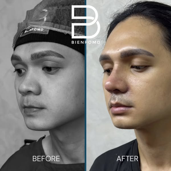 Why Rhinoplasty Is More Than Making the Nose Smaller thumbnail